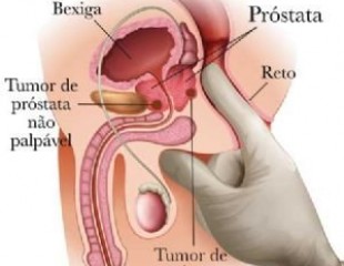 Cancerul de prostata - cauze, simptome si tratament - BodyGeek